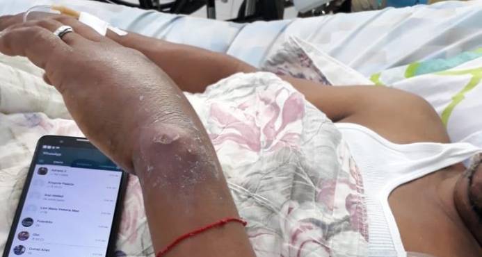 DENUNCIAN EN CELDA DE LA POLICIA EN MAO HAY PRESOS CON GUSANOS EN LA PIEL