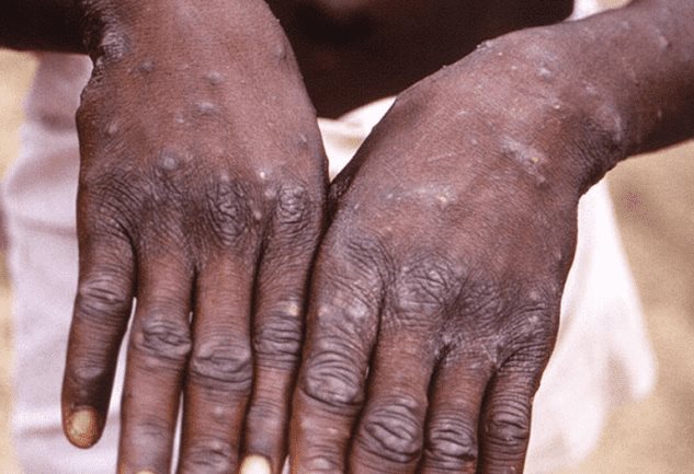 Haitiano en Ocoa es el décimo caso de viruela símica en RD