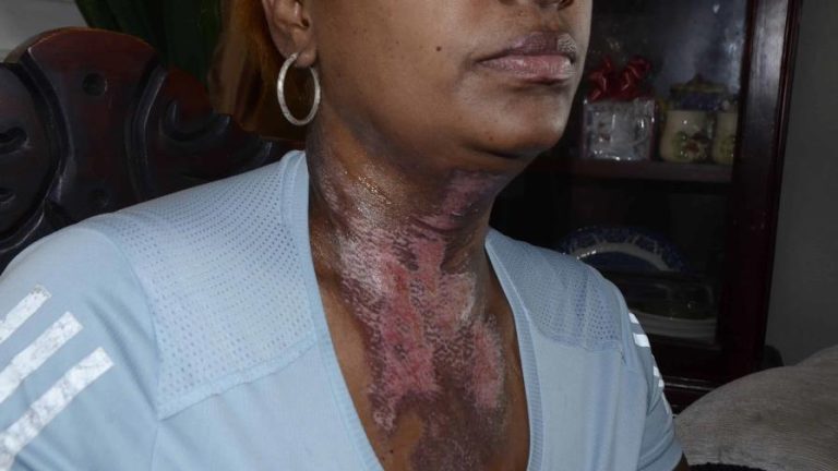 Mujer denuncia esta abanonada por autoridades luego que su ex pareja intentara matarla