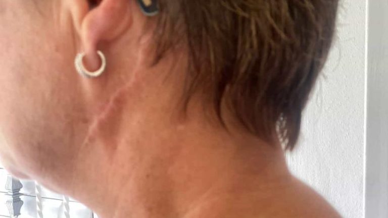 Mujer herida de tres machetazos por su hermano, teme por su vida